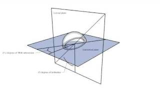 Anteversion and inclination of an acetabular cup [upl. by Cass589]