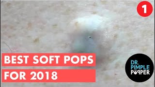 The BEST OF Softpops 2015 for 2018 Part 1 Dr Pimple Popper [upl. by Pansir]