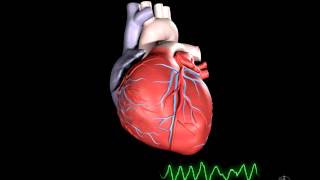 What is Ventricular Fibrillation [upl. by Claresta]