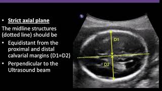 TMT FETAL IMAGING Imaging The Lateral Ventricles  ALPANA JOSHI  Fetal Hydrocephalus [upl. by Yesmar]