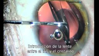 Lente intraocular para el tratamiento de la miopia hipermetropia y astigmatismo [upl. by Caine]