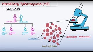 Hereditary Spherocytosis HS  Pathophysiology [upl. by Enelyad]