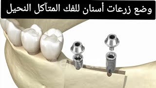 زراعة الأسنان للفك المتآكل النحيل Dental Implants for resorbed ridge [upl. by Pax158]