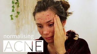 Normalising Acne  Documentary  Cerys Davies [upl. by Aral102]