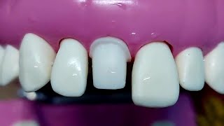 ازاى تعمل Reduction بسهوله  All ceramic crown preparation for upper central upper1drghazal [upl. by Jeaz]