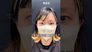 本気の二重切開がすごい結果に。二重整形 二重になる方法 二重 二重切開 美容整形 整形 垢抜け 切開法 [upl. by Ardnasela379]