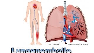 Lungenembolie  Krankheiten der Blutgefäße  Pflege Kanal [upl. by Nylanaj]