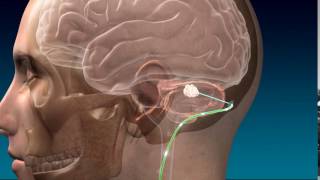 Deep Brain Stimulation for Stroke Recovery Animation [upl. by Divod766]