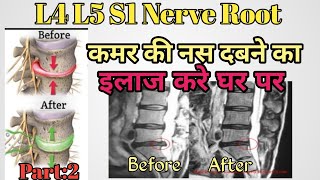 L4 L5 S1 nerve root compression exercises  buldging Disc exercises  Herniated Exercise  in hindi [upl. by Rett562]