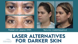 Laser Treatment Alternatives for Darker Skin [upl. by Etnovahs]