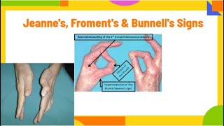 jeannes froments amp Bunnells signs  ulnar neuropathy PhysiotherapyKnowledge [upl. by Noyerb]