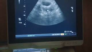 Osseous metaplasia uterus pelvicultrasound pathology [upl. by Dannon]