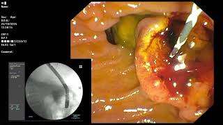 ERCP  Impacted CBD stones removal [upl. by Thedrick]