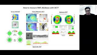 Lecture How to Interpret OCT Findings in the Diagnostic Evaluation of Glaucoma [upl. by Serilda]