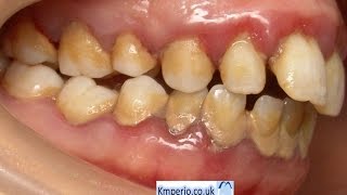 Treatment of Periodontal DiseaseBefore and After [upl. by Sair169]