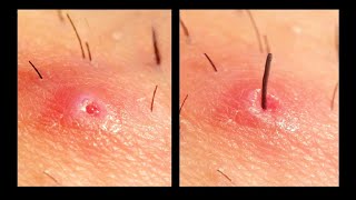 Ingrown hair removal [upl. by Eilyr]