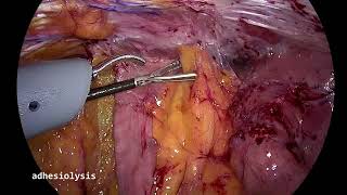 Lparoscopic Hartmann Reversal Metin Ertem MDFACS [upl. by Samoht974]