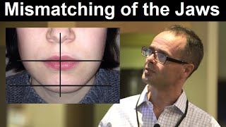 Effect of Midline Discrepancy Mismatching or Facial Asymmetry on Facial Appearance by Dr Mike Mew [upl. by Dorreg914]