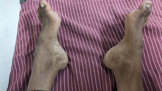 Pes cavus and equinovarus deformities in Neurology DrKamaleshTNMediCalLectures [upl. by Itaws]