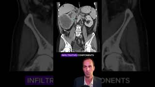 Renal cell carcinoma CT interpretation radiology medicalstudent radiologist radiographer [upl. by Zoes]