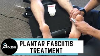 Plantar Fasciitis Treatment San Diego Graston Chiropractic [upl. by Nuahsyar]