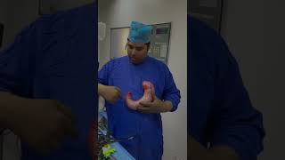 What is removed in sleeve Gastrectomy drrksingh bariatric definitecure obesity [upl. by Malley592]