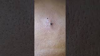 Another huge back Blackhead Squeeze [upl. by Naimaj]