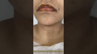 Lip Pigmentation Treatment✨❤️ [upl. by Pillihpnhoj]