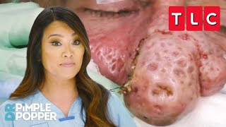 Bumpiest Nose Growths  Dr Pimple Popper  TLC [upl. by Mukul]