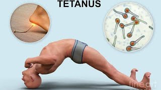 Tetanus Disease tetanusvaccine tetanus tetanusymptoms tetanusdiseaseinurdu [upl. by Llemor536]