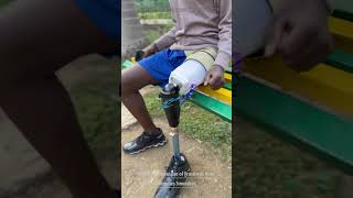 Above Knee Prosthesis  Stages of Prosthetic Training  Walking with Transfemoral Prosthetic Leg [upl. by Waiter]