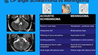 CP Angle tumors Schwannoma Meningioma [upl. by Finny925]