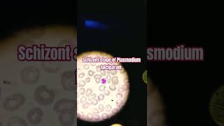 Schizont stage of Plasmodium falciparum  Malarial Parasitology [upl. by Yeliac355]