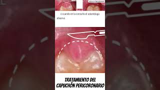 Tratamiento del capuchón pericoronario Operculectomía ovidental [upl. by Shyamal]