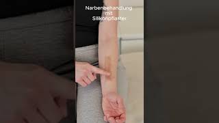 Narbenbehandlung mit Silikonpflaster [upl. by Letsyrk]