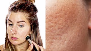 Dos And Donts To Applying Makeup On Pitted Acne Scars  Icepick Scars Boxcar scars [upl. by Llednar]