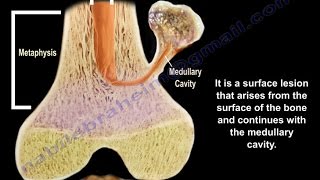 Osteochondroma  solitary and multiple  Everything You Need To Know  Dr Nabil Ebraheim [upl. by Llehsram]