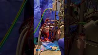 Perfusion aspects by a clinical Perfusionist perfusion nurse [upl. by Ramos990]