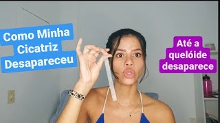 Como Minha Cicatriz De Silicone DesapareceuAdeus quelóide Lifesil vs Drenison [upl. by Rhynd]