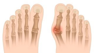 How to Know If You Have a Bunion  Foot Care [upl. by Naaman]