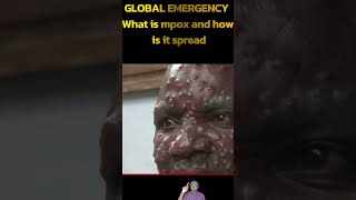 GLOBAL EMERGENCY What is mpox and how is it spread breakingnews news missionfieldtv [upl. by Aleen737]