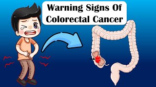 Warning Signs Of Colon Cancer  What Are The Early Signs amp Symptoms Of Colon Cancer [upl. by Heyman]