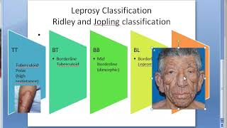 Pathology 160 a Leprosy Classification Difference Tuberculoid Lepromatous Ridley jopling TT BT BB LL [upl. by Namdor412]