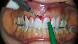 Gingivectomy  Procedure to eliminate suprabony pockets  Dental Clinic [upl. by Lowenstein]