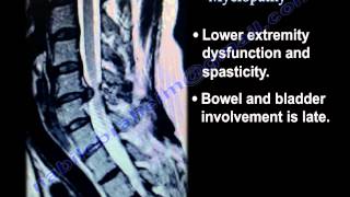 Cervical Spine Myelopathy  Everything You Need To Know  Dr Nabil Ebraheim [upl. by Marni]