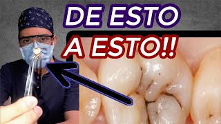 Caries dentales ¿COMO SABER si TENGO CARIES 🤕 ¿Qué son las CARIES DENTALES y como se PRODUCEN 🦷👈 [upl. by Gardas]