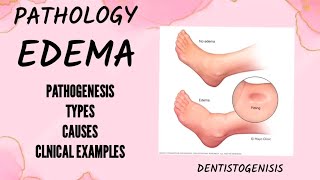 edema  oedema  pathology bds2ndyear bds pathology [upl. by Hillinck235]