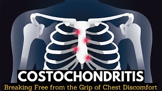 Costochondritis Breaking Free from the Grip of Chest Discomfort [upl. by May]