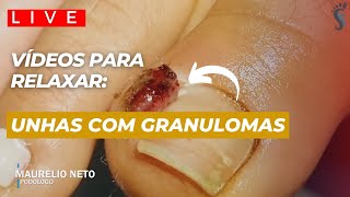 UNHAS MUITO INFLAMADAS E COM GRANULOMAS podologomaurelio ingrowntoenail [upl. by Ireland868]