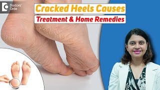 10 Home Remedies for CRACKED HEELS  Magical Cracked Heel RemediesDr Amee Daxini  Doctors Circle [upl. by Haras]